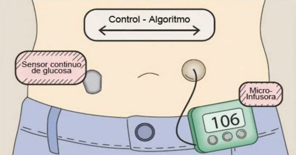 páncreas artificial