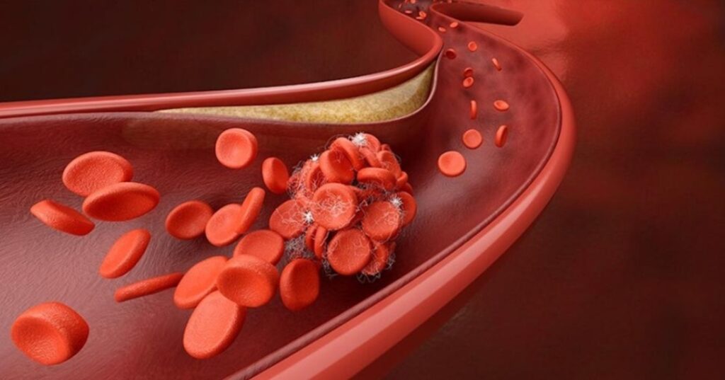 Detección de coágulos sanguíneos