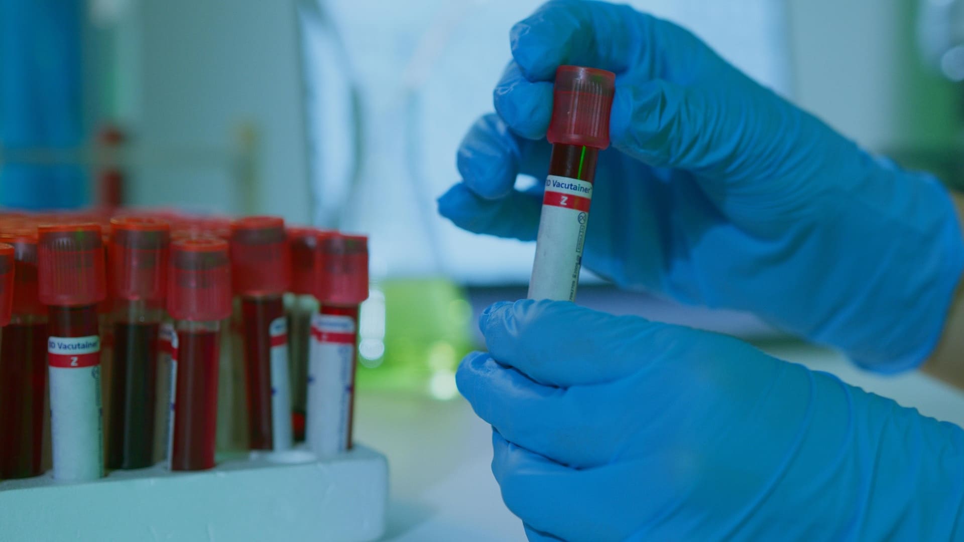 Análisis de sangre esclerosis múltiple