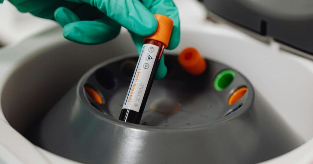 Análisis de sangre esclerosis múltiple