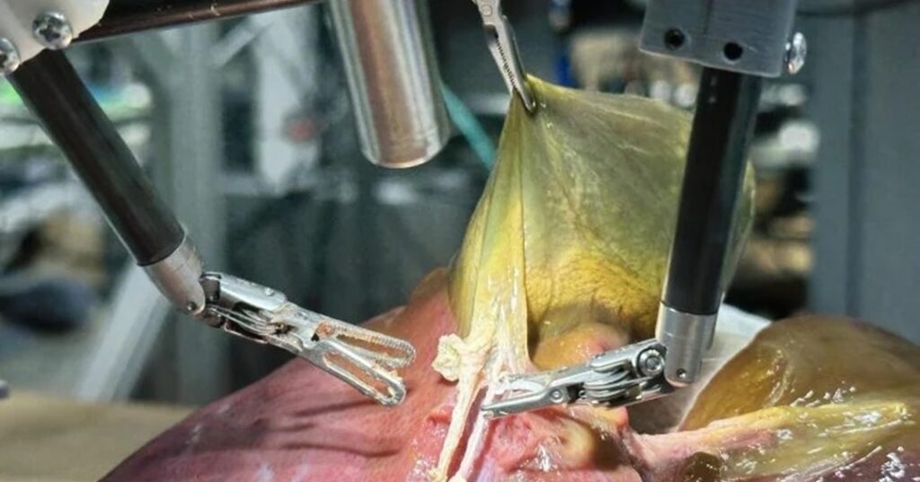 Cirugía asistida con inteligencia artificial